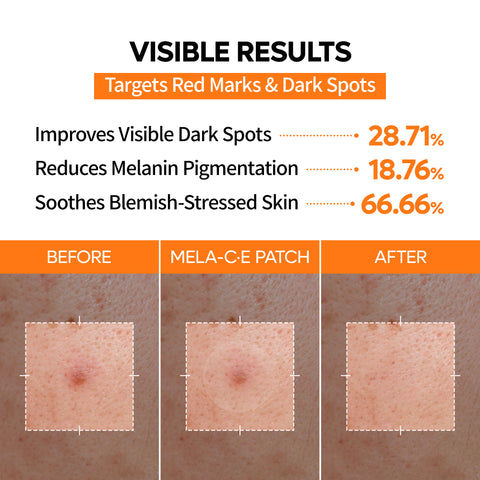 Zero-Fit Blemish & Dark Spot Patch Duo (144 Patches)