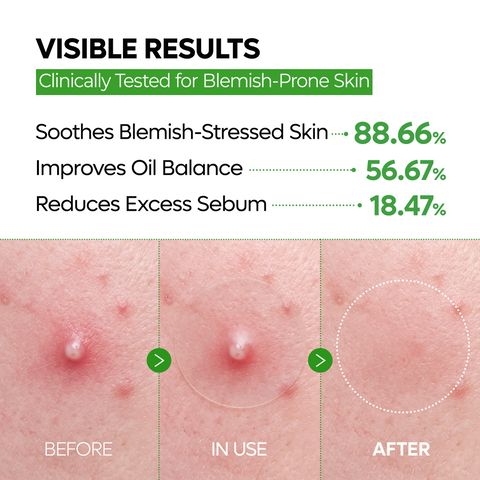 Zero-Fit Blemish & Dark Spot Patch Duo (144 Patches)